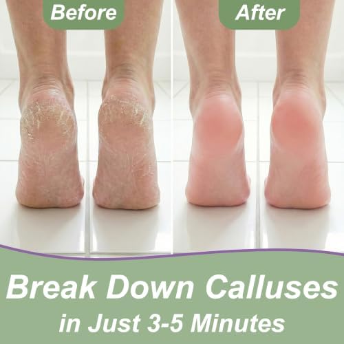 Callus Remover for Feet (Extra Strength 8 oz) Foot Callus Remover Gel