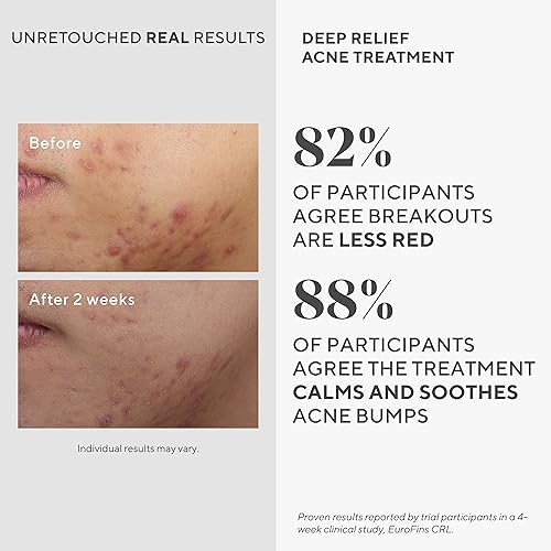 Murad Deep Relief Acne Spot Treatment - 2% Salicylic Acid - 1 Fl Oz
