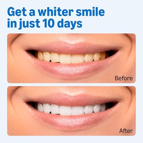 Amazon Basics 10 Day Teeth Whitening Strips Kit, 10 Treatments, 1-Pack, Packaging May Vary